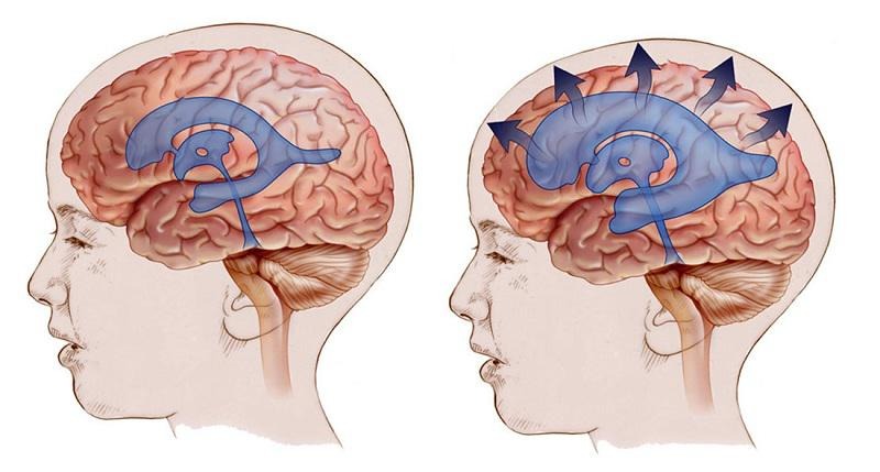 Pseudotumor Cerebri Pseudotumor cerebri (idiopathische intrakranielle Hypertension)