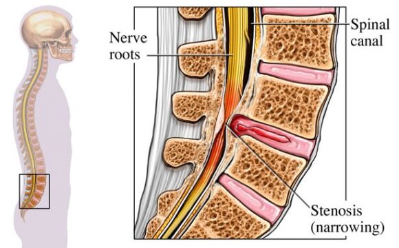 Spinalkanalstenose