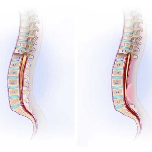 Was ist das Tethered-Cord-Syndrom?
