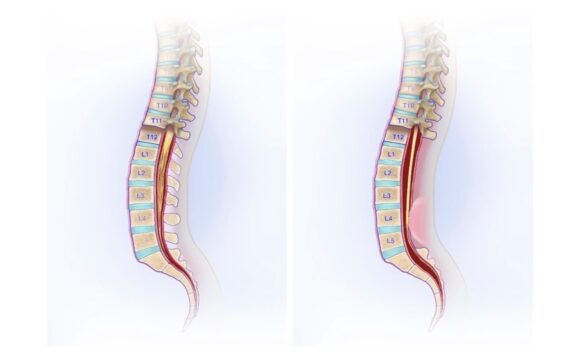 Was ist das Tethered-Cord-Syndrom?