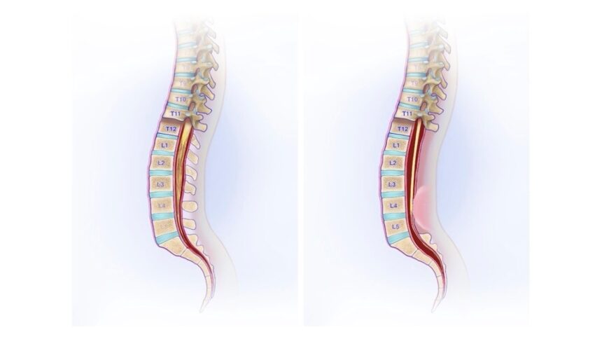Was ist das Tethered-Cord-Syndrom?