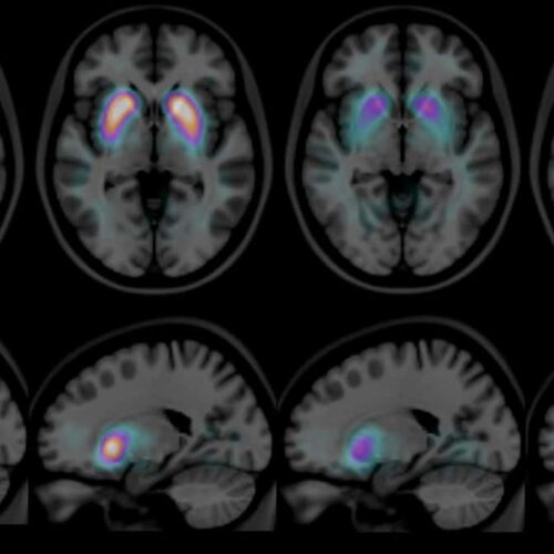 Häufige Fragen zur Demenz